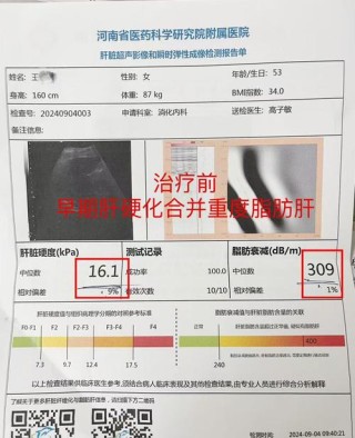 baidu09显著改善肝组织病变，NASH创新疗法公布3期试验更多积极结果