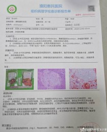 百度拜读09baidu显著改善肝组织病变，NASH创新疗法公布3期试验更多积极结果