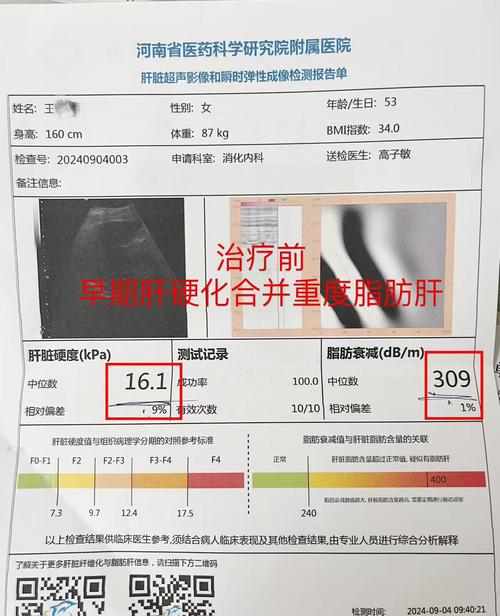 baidu09显著改善肝组织病变,NASH创新疗法公布3期试验更多积极结果 第1张 baidu09显著改善肝组织病变,NASH创新疗法公布3期试验更多积极结果 第1张