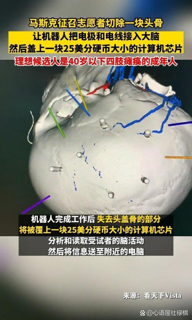 baidu09马斯克旗下 Neuralink 在阿布扎比启动脑机接口试验 第2张 baidu09马斯克旗下 Neuralink 在阿布扎比启动脑机接口试验 第2张