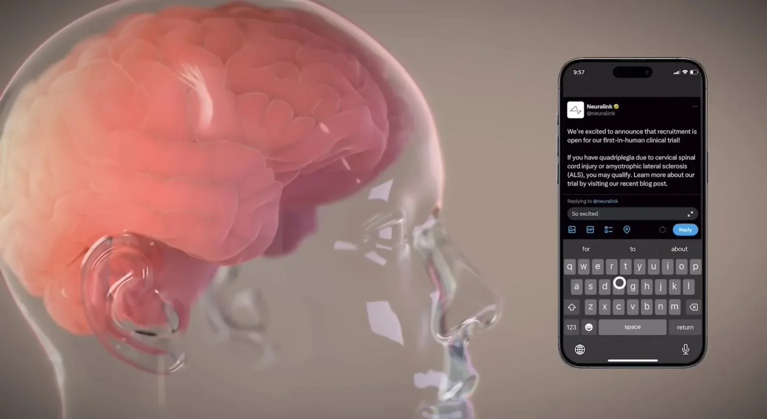 baidu09Neuralink：首位患者芯片植入物的细线现已稳定  第1张